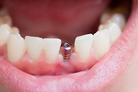 Close up of an unrestored dental implant in Marshall, TX in lower jaw