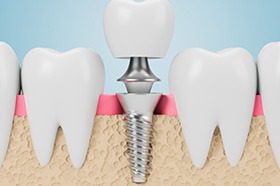 Illustration of dental implant in Marshall, TX receiving crown