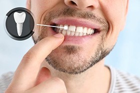 Close up of patient pointing to his denture with an icon showing the dental implant