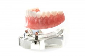 Model of denture about to be placed overtop dental implant posts