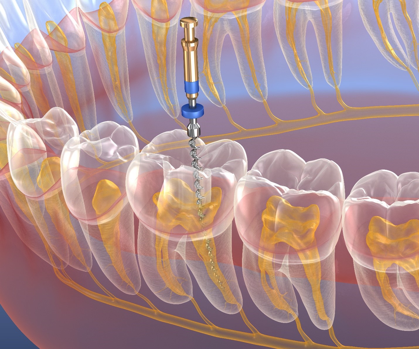 i-m-not-in-pain-why-do-i-need-a-root-canal