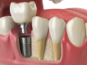 3D model of a dental implants