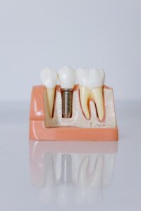 Dental implant model on counter